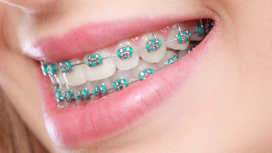 Cost of Braces in Texas: A Comprehensive Guide