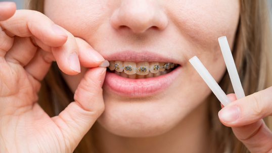 How to Use Orthodontic Wax