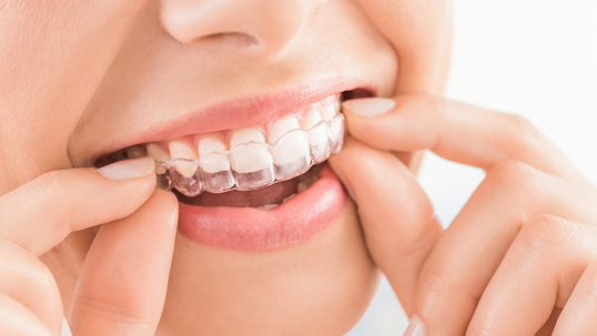 What to Do If You Ruin Your Clear Aligners