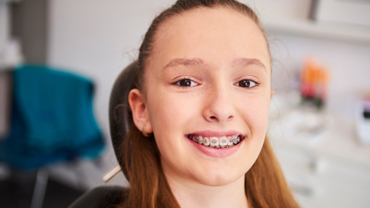 How Long Do You Need to Wear Braces? Clear Answers and Realistic Timelines