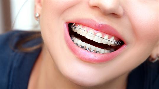 What to Know Before Getting Clear Ceramic Braces